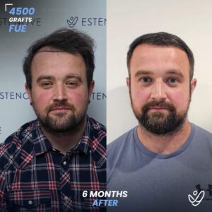 Male FUE 4500 Grafts 6 Months Before&After