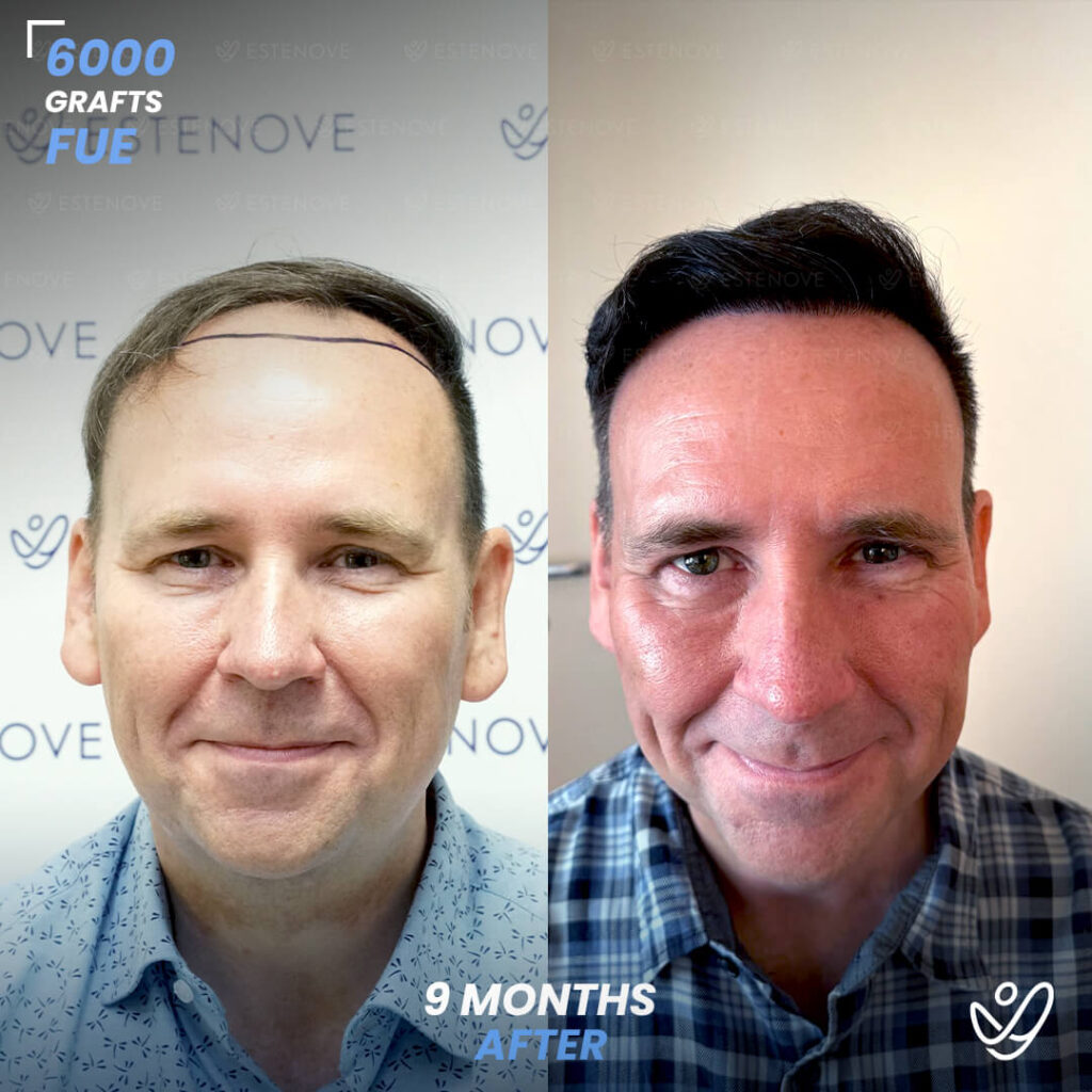 Male FUE 6000 Grafts 9 Months Before&After