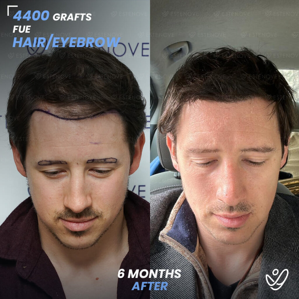 FUE 4400 Grafts 6 Months Before&After
