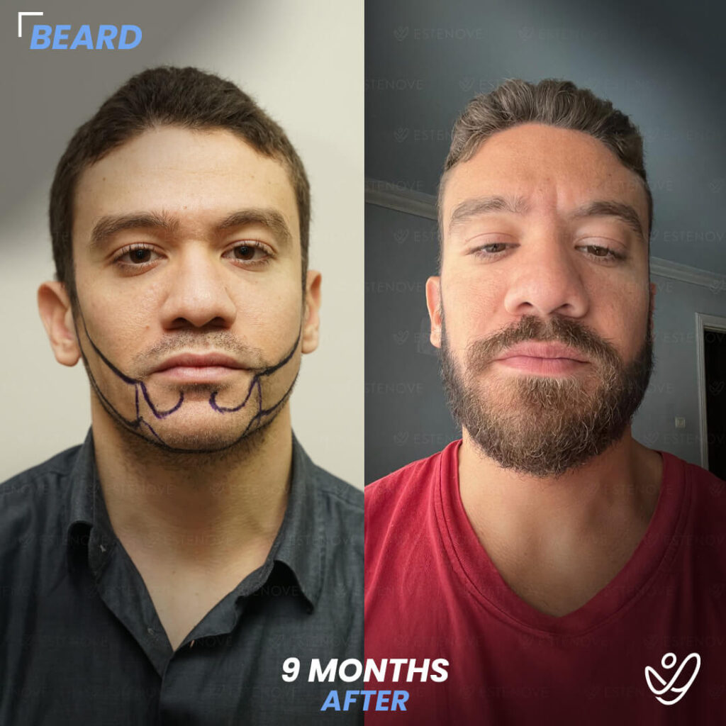 Beard Transplant 9 Months Before&After