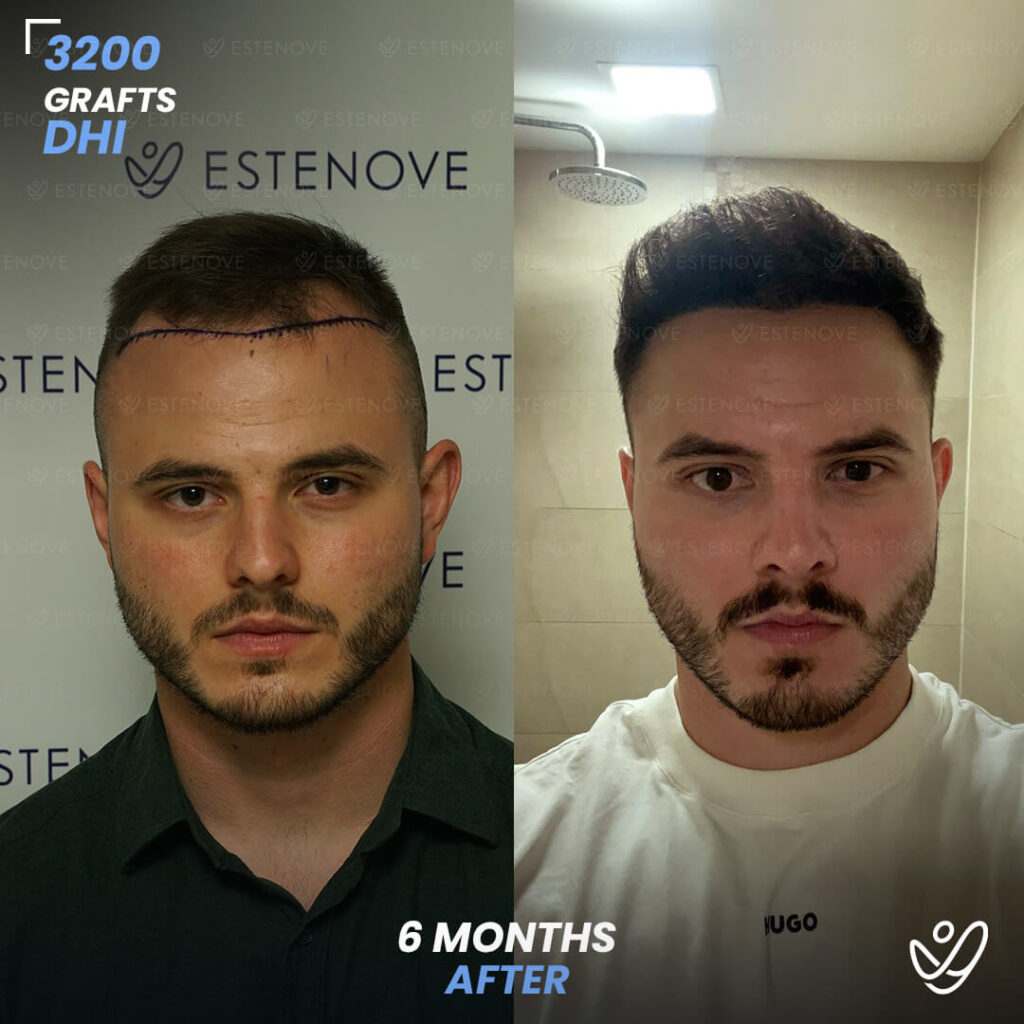 Male DHI 3200 Grafts 6 Months Before&After Male DHI 3200 Grafts 6 Months Before&After