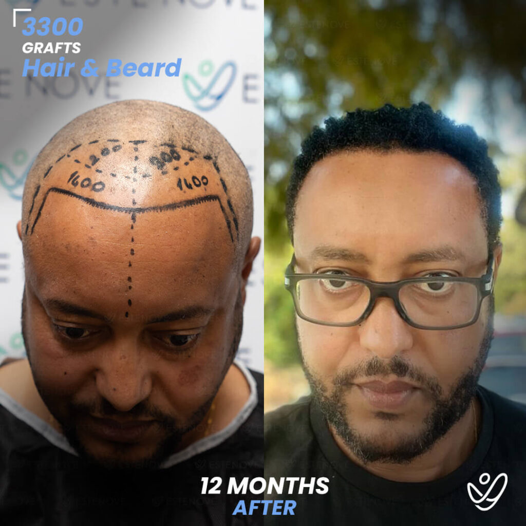 Hair&Beard Transplant 3300 grafts 12 Months Before&After