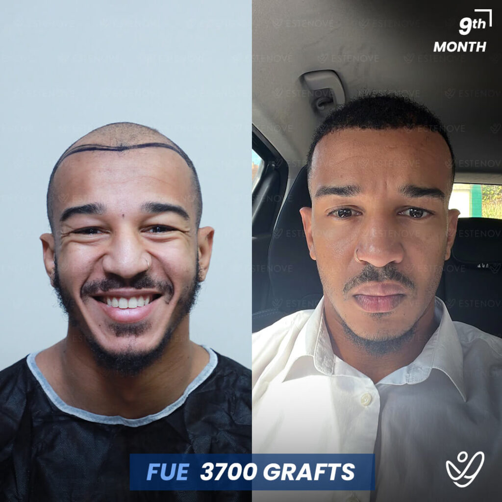 Male FUE 3700 Grafts 9 Months Before&After Male FUE 3700 Grafts 9 Months Before&After