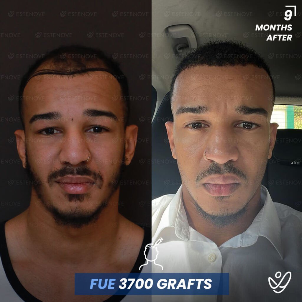Male FUE 3700 grafts 9 Months Before&After
