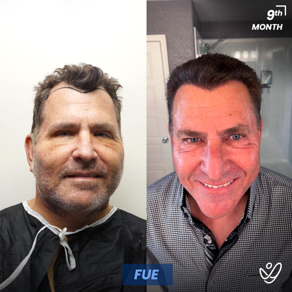 Male FUE 9 Months Before&After Male FUE 9 Months Before&After
