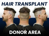 text saying hair transplant donor area, photo of a man with marked donor are on the back of his head