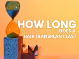 how long does a hair transplant last