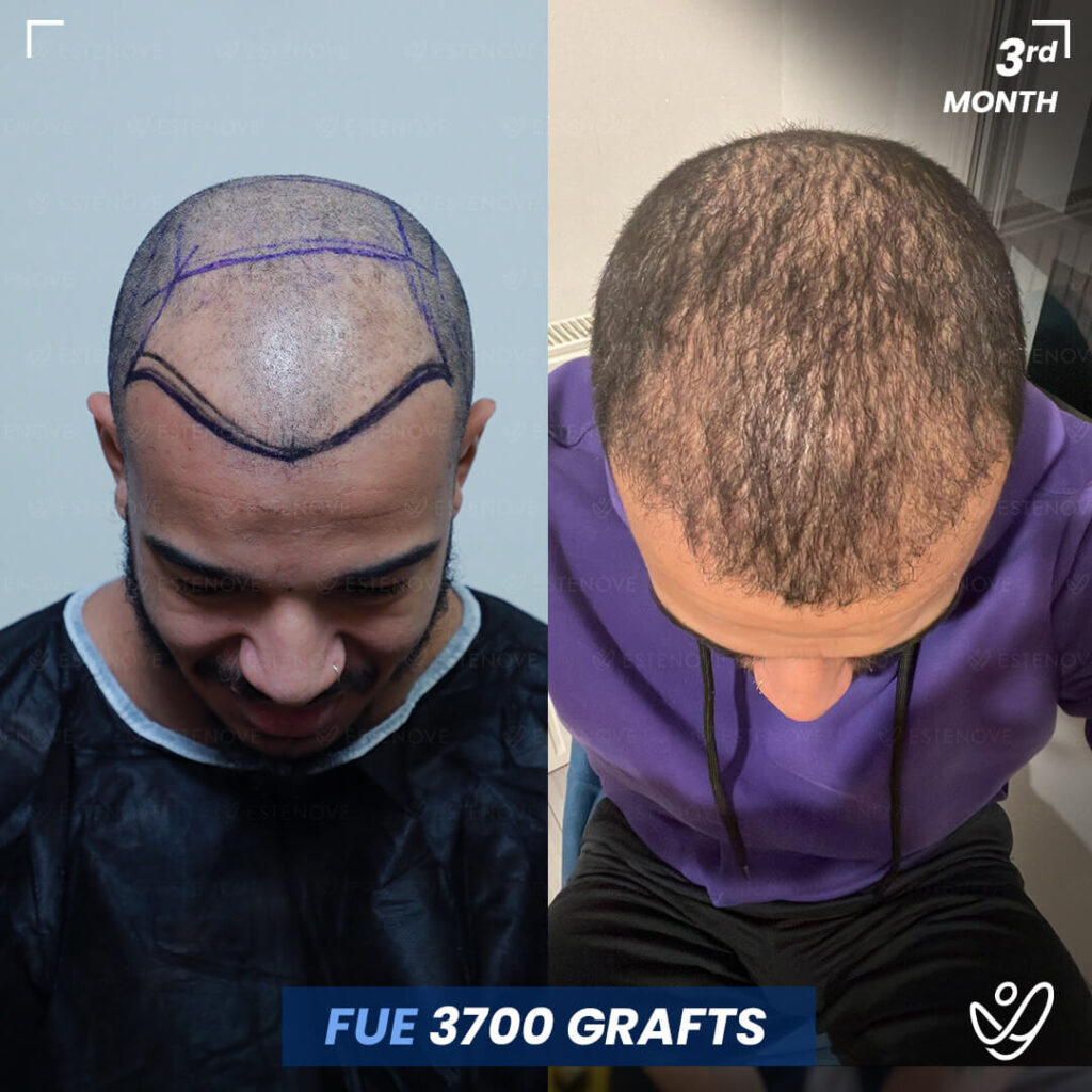 Male, FUE, 3 Months After Hair Transplant, 3700 Grafts