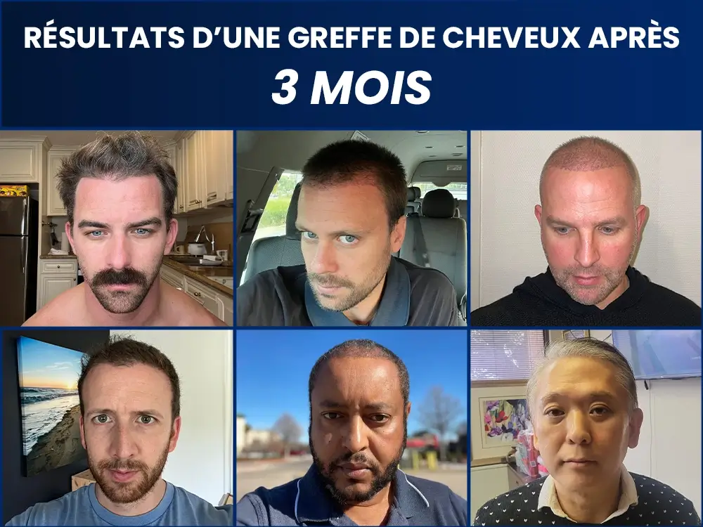 RÉSULTATS D’UNE GREFFE DE CHEVEUX APRÈS 3 MOIS