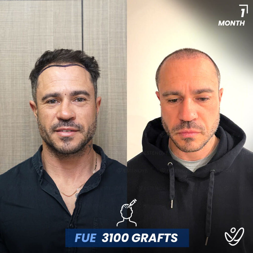 FUE Hair Transplant, 1 Month Before After, 3100 Grafts FUE Hair Transplant, 1 Month Before After, 3100 Grafts