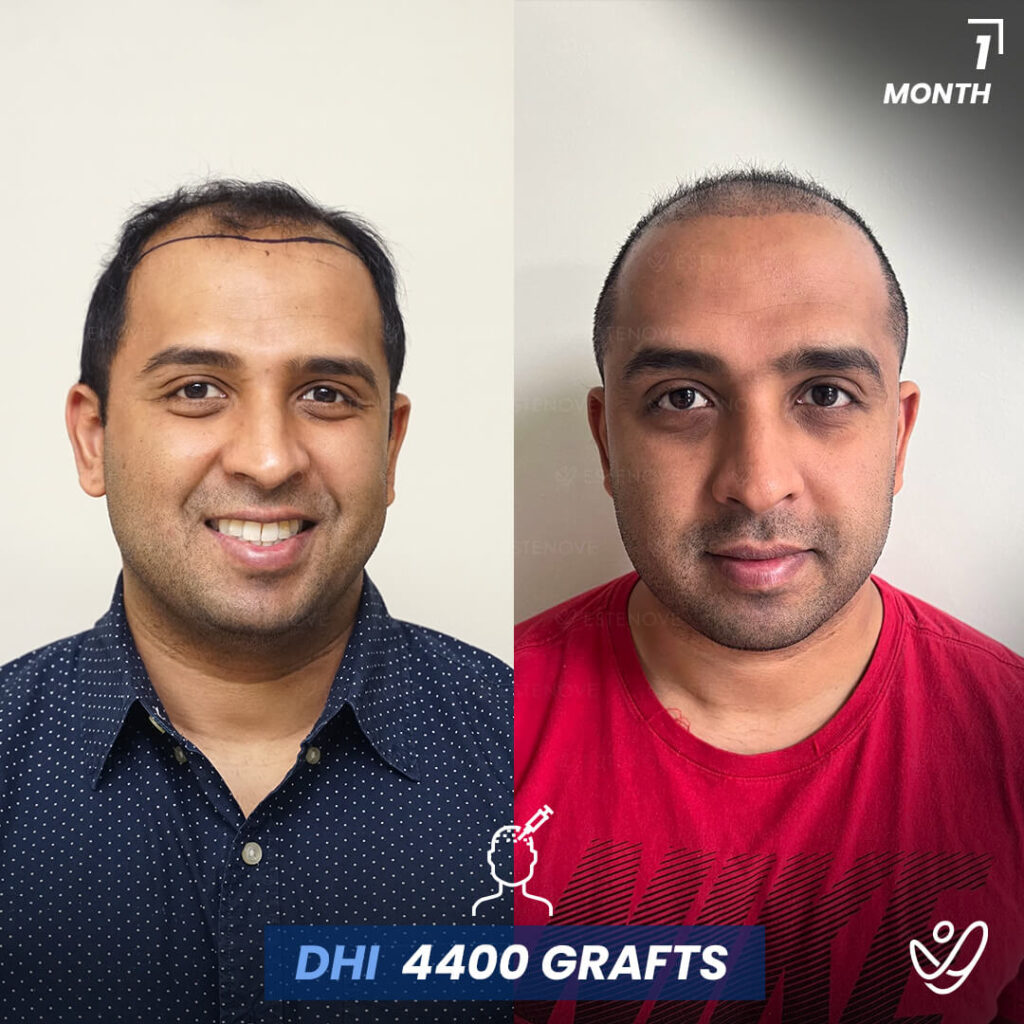 DHI 1 Month Before After, 4400 Grafts DHI 1 Month Before After, 4400 Grafts