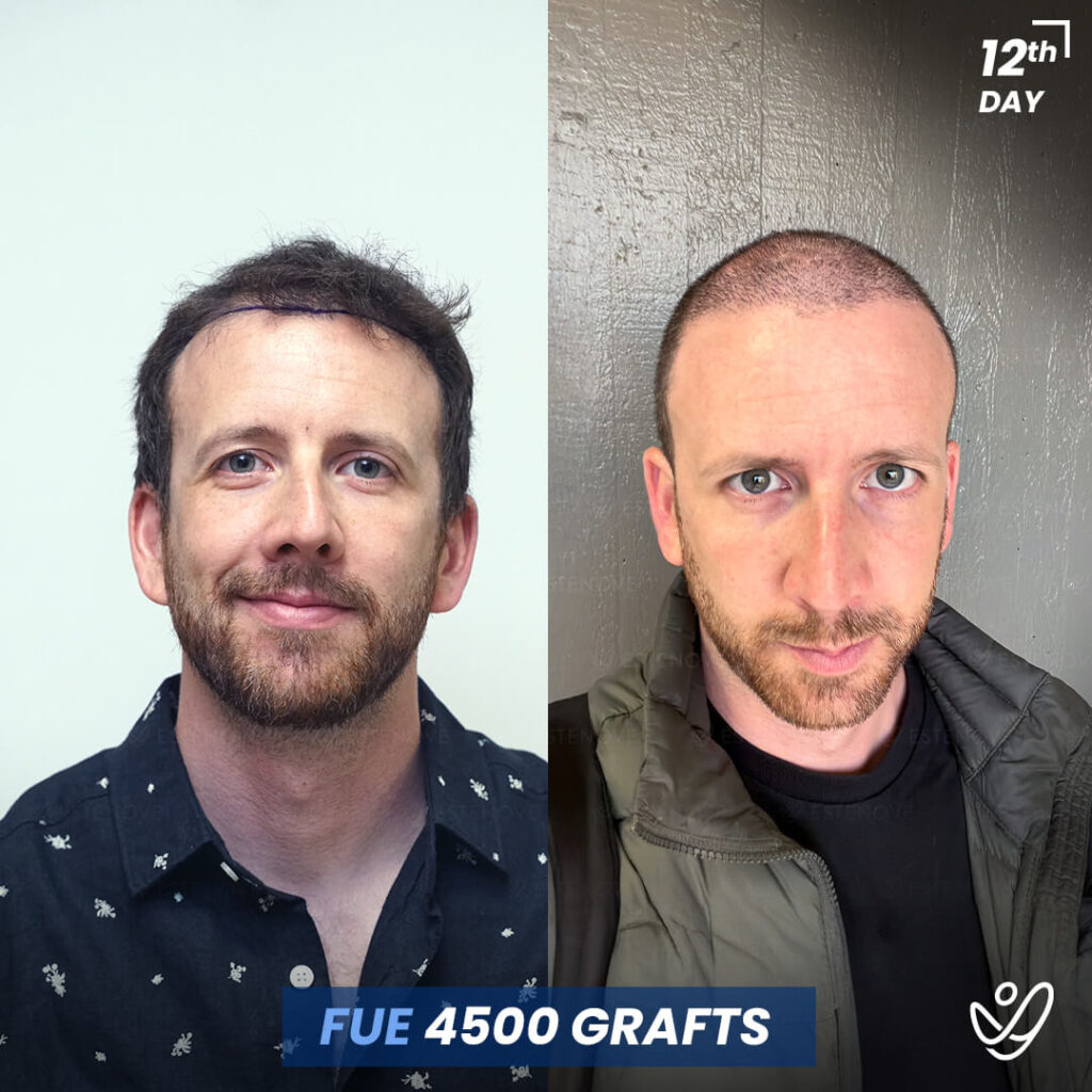 MARC-ANDRE-BAAUILANNE