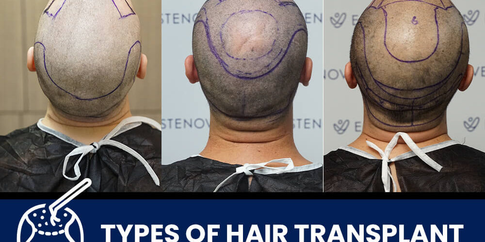 Types-of-Hair-Transplant-Techniques-in-Turkey