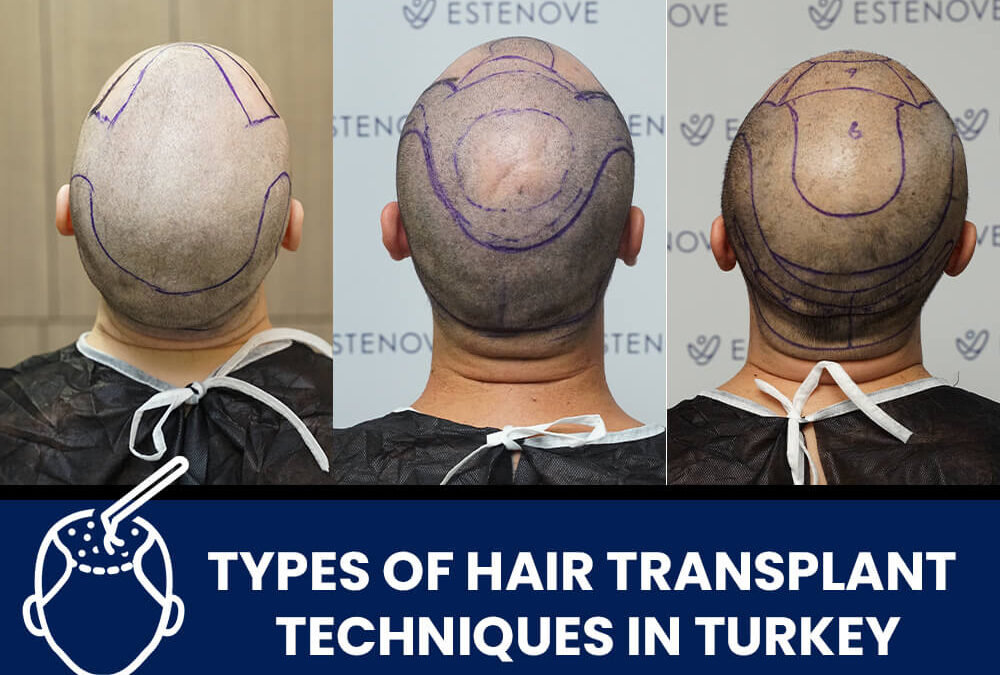 Types-of-Hair-Transplant-Techniques-in-Turkey