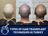 Types-of-Hair-Transplant-Techniques-in-Turkey
