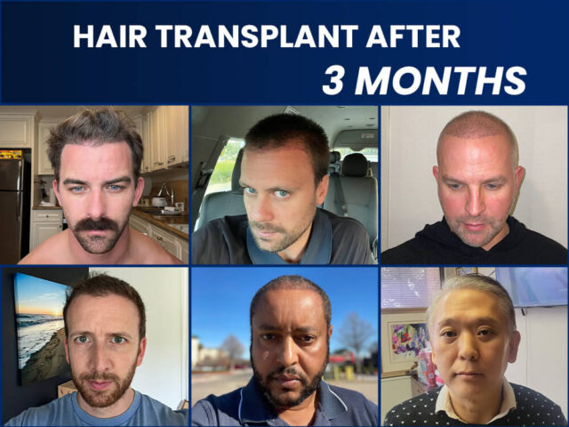 Résultats de greffe de cheveux après 3 mois