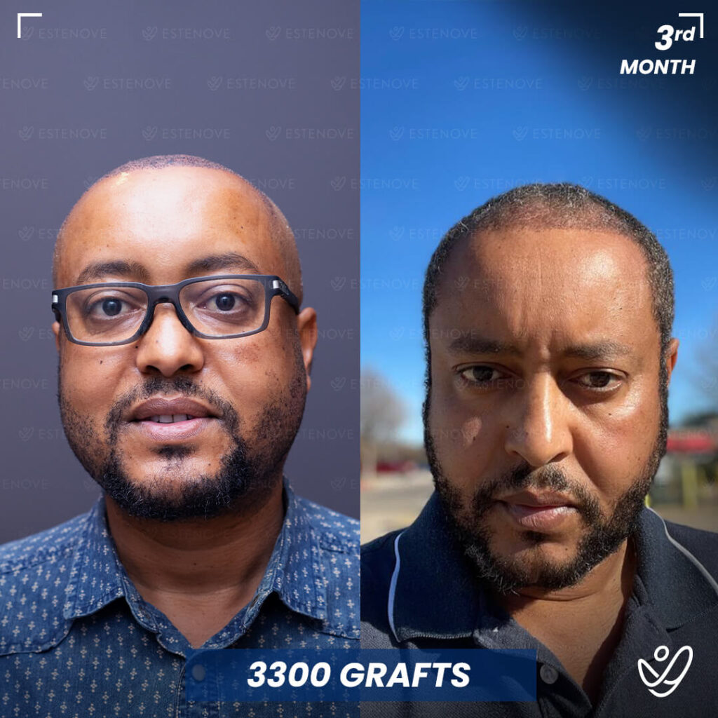 Male 3300 Grafts Hair Transplant, 3 Months After Male 3300 Grafts Hair Transplant, 3 Months After