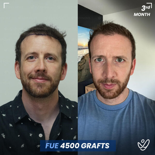Greffons masculins FUE 4500 3 mois avant et après
