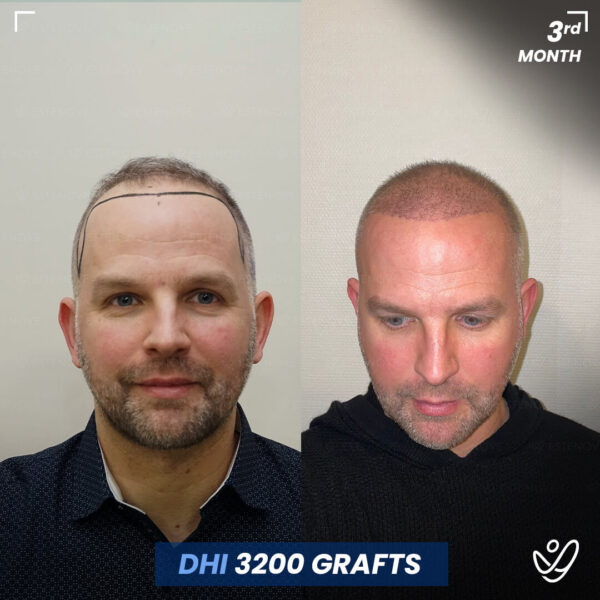 Homme, DHI, 3 mois après greffe de cheveux, 3200 greffes