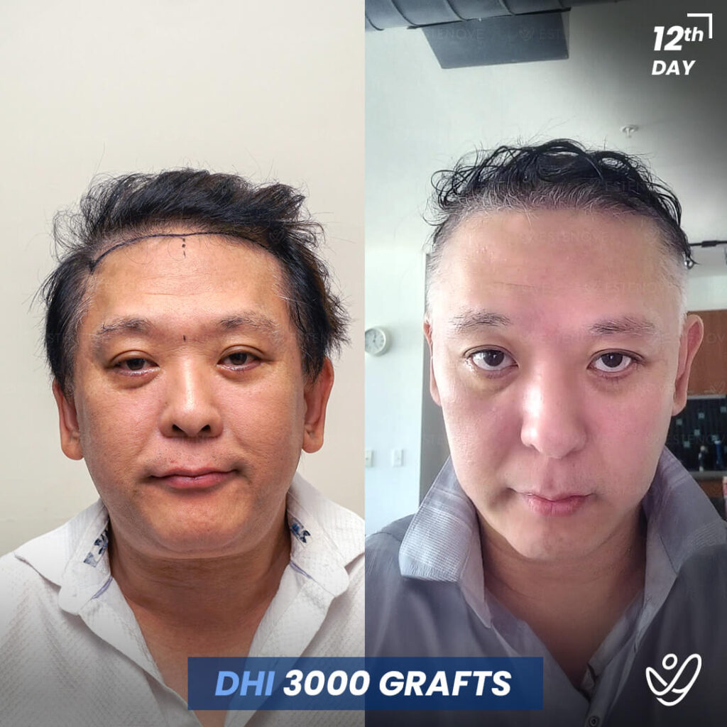 Male, DHI, 12 Days After Hair Transplant, 3000 Grafts Male, DHI, 12 Days After Hair Transplant, 3000 Grafts