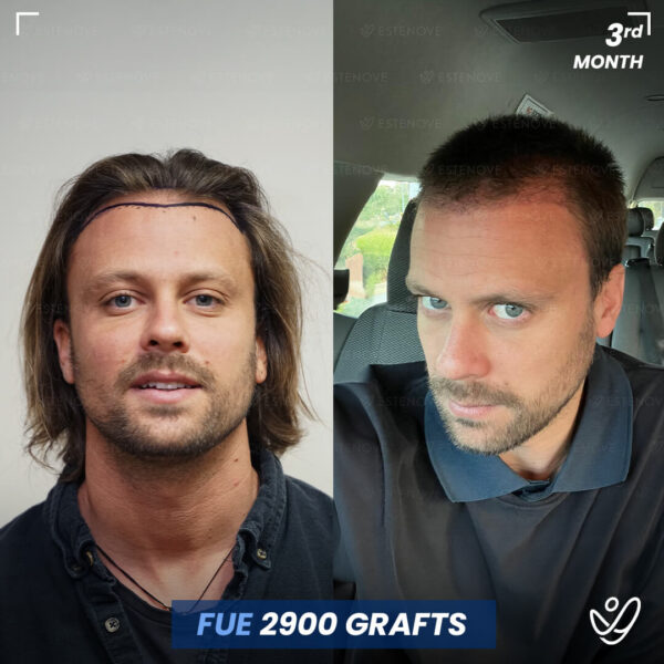 Homme, FUE, 3 mois après greffe de cheveux, 2900 greffons