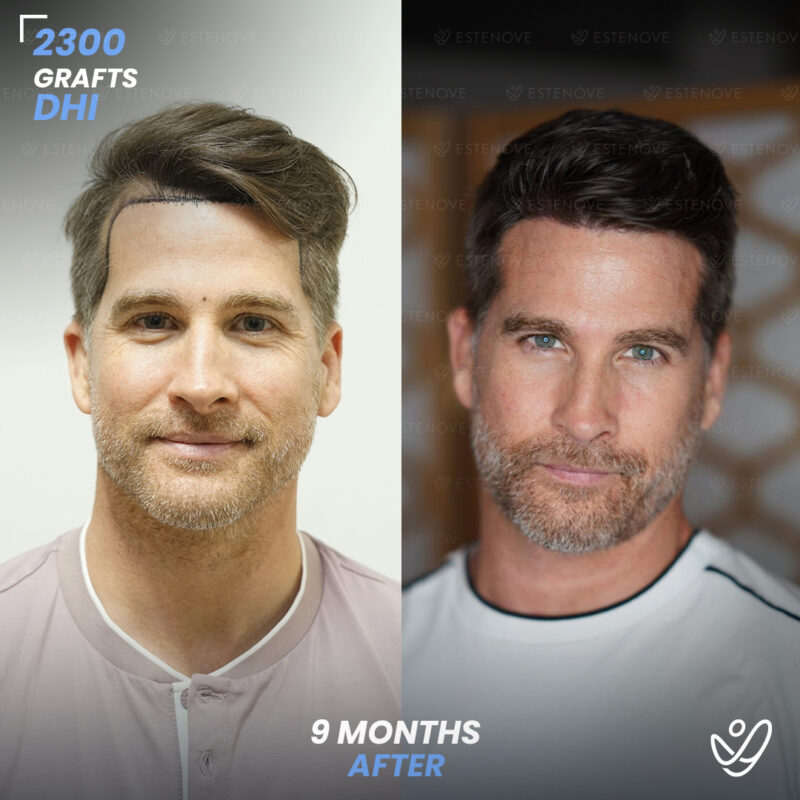 DHI 2300 Hair Grafts, 9 Months Before After DHI 2300 Hair Grafts, 9 Months Before After