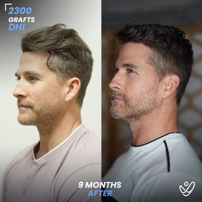 DHI 2300 Hair Grafts, 9 Months Before After DHI 2300 Hair Grafts, 9 Months Before After