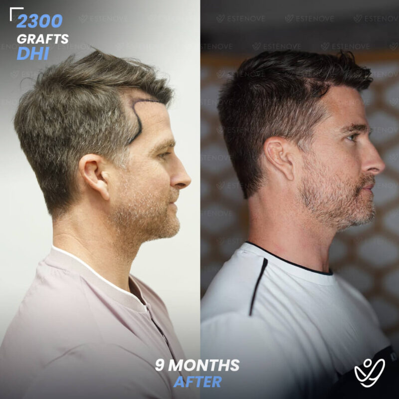 DHI 2300 Hair Grafts, 9 Months Before After DHI 2300 Hair Grafts, 9 Months Before After