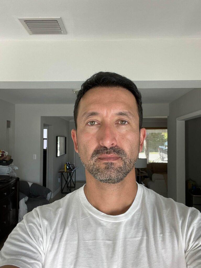 Wilmer Sanchez 5200 + 2950 Grafts Hair Transplant