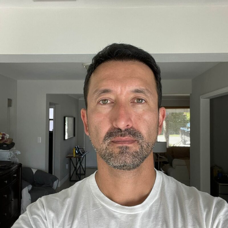 Wilmer Sanchez 5200 + 2950 Grafts Hair Transplant Wilmer Sanchez 5200 + 2950 Grafts Hair Transplant