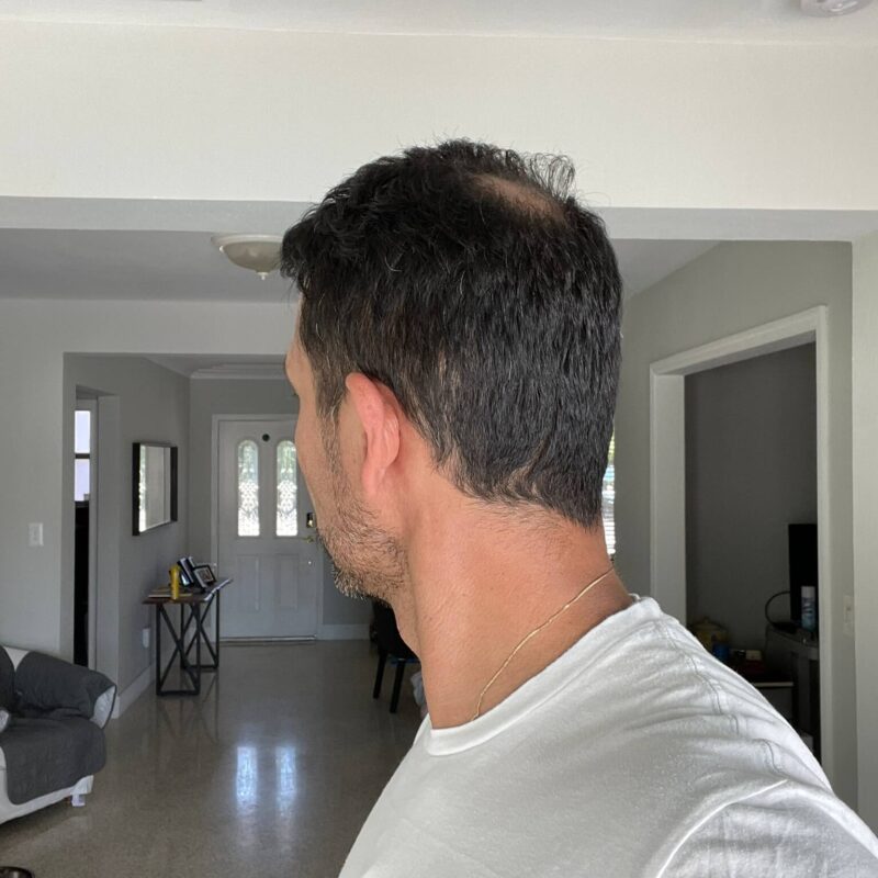 Copy of WhatsApp Image 2023-01-10 at 23.08.57 (2) After First Hair Transplant Photos (5200 Grafts)