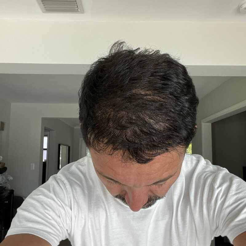 Copy of WhatsApp Image 2023-01-10 at 23.08.57 (3) After First Hair Transplant Photo (5200 Grafts)