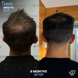 DHI 3500 Hair Grafts, 6 Months Before After - Randy Lehoe