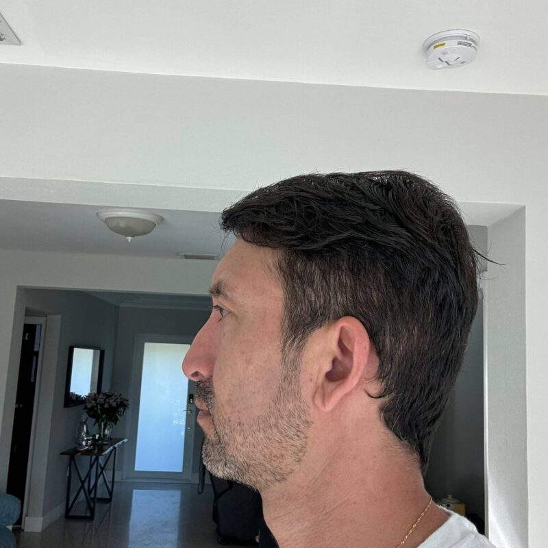 WhatsApp Image 2023-10-31 at 16.32.23 (2) After Second Hair Transplant Photo (2950 Grafts)