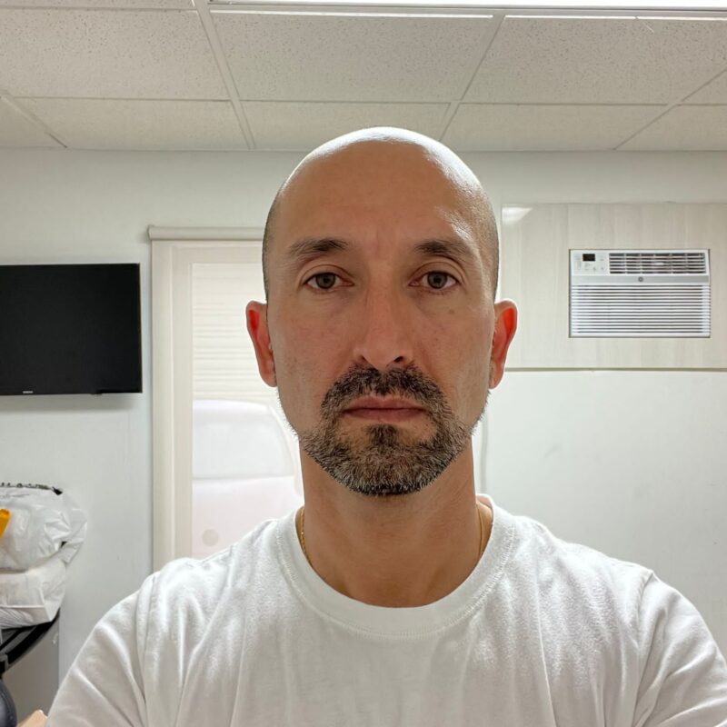 Before Hair Transplant Photo Before Hair Transplant Photo