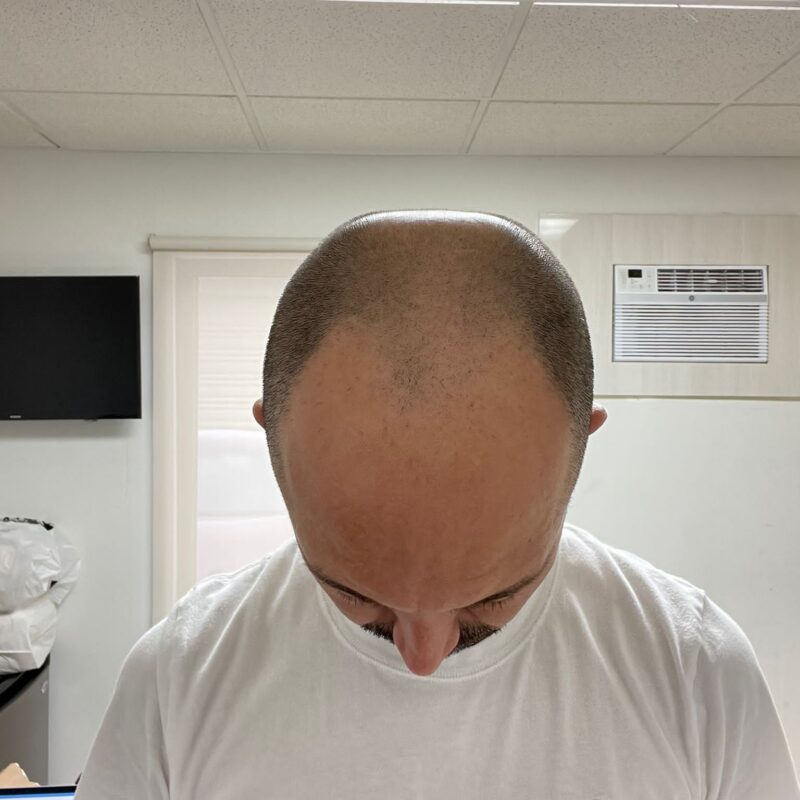 Before Hair Transplant Photo Before Hair Transplant Photo