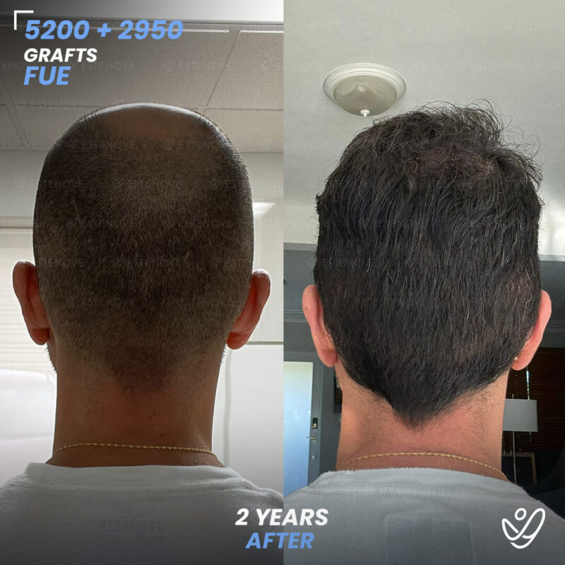 Wilmer_Sanchez Second Hair Transplant Before After - FUE 5200 + 2950 Grafts - Wilmer Sanchez