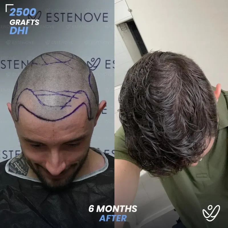 DHI 2500 grafts hair transplant 6 months after DHI 2500 grafts hair transplant 6 months after