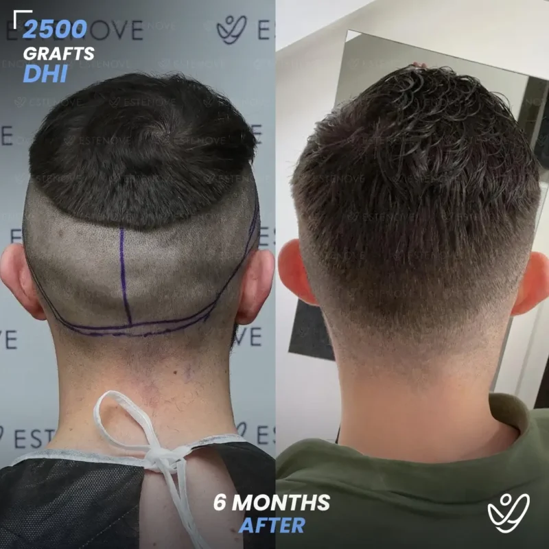 DHI 2500 grafts hair transplant 6 months after DHI 2500 grafts hair transplant 6 months after