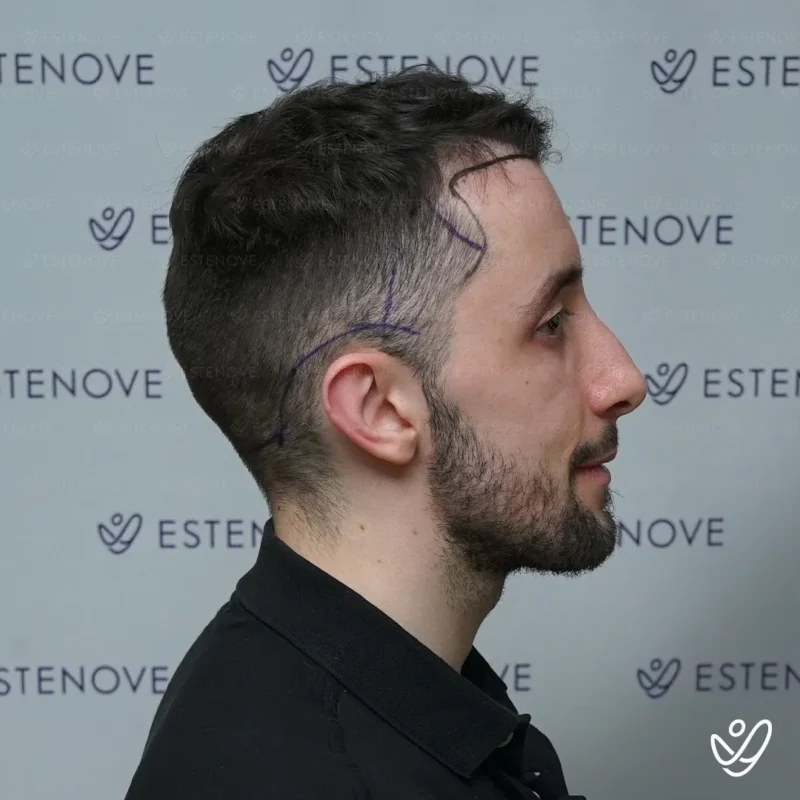 2 before hair transplant right side