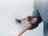 dht and hair loss causes