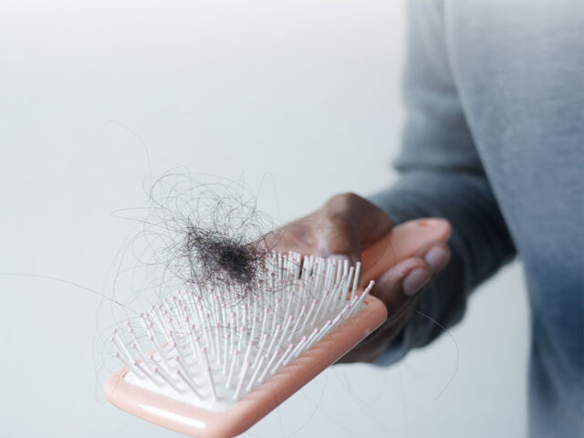 dht and hair loss causes