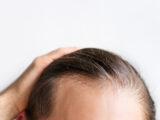 diffuse thinning causes
