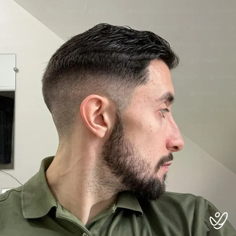 3 after hair transplant right side