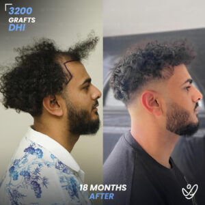 3200 Grafts Hair Transplant Before After - Right Side