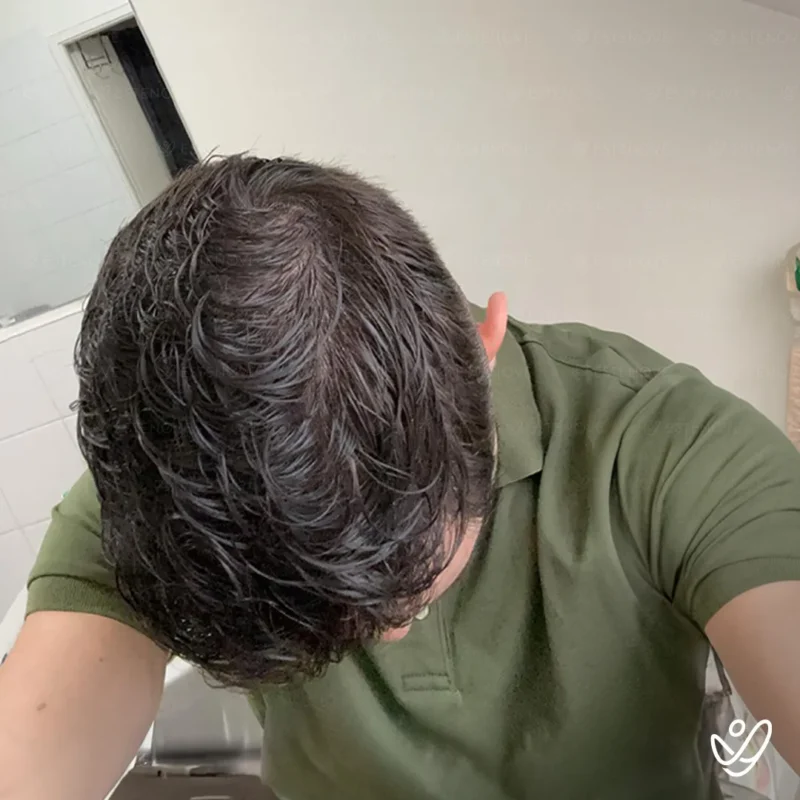 7 after hair transplant top