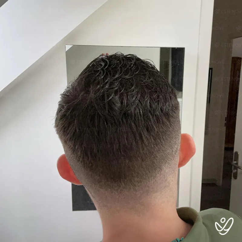 9 after hair transplant back side