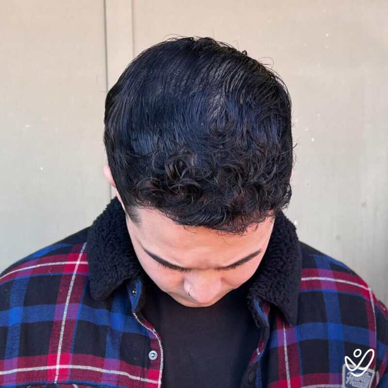 After Hair Transplant Photo (4500 grafts FUE) After Hair Transplant Photo (4500 grafts FUE)