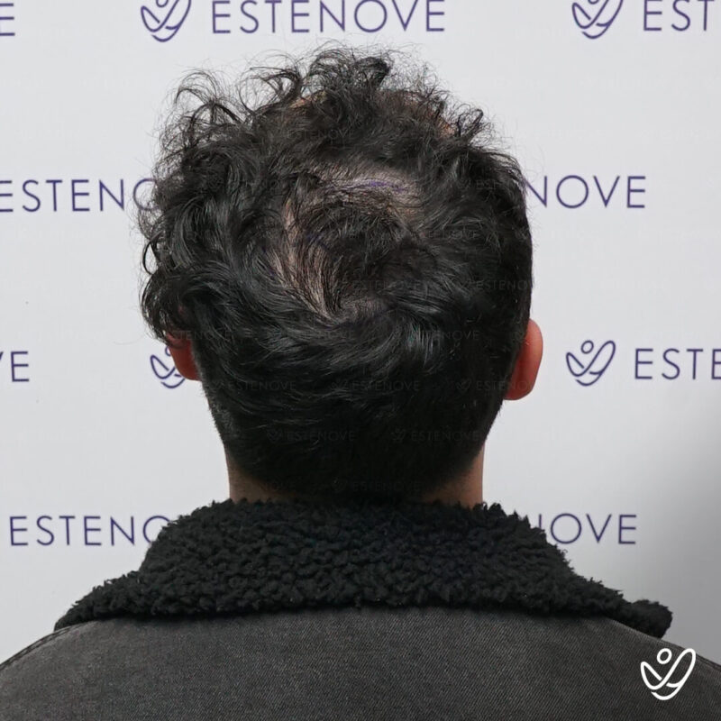 FUE 4500 Grafts Before Hair Transplant Photo FUE 4500 Grafts Before Hair Transplant Photo