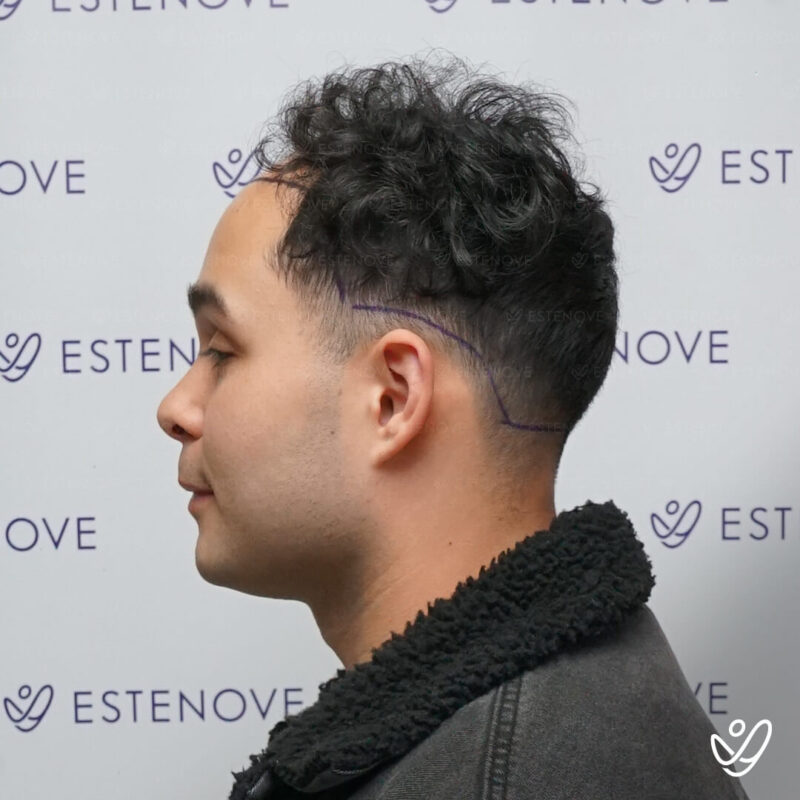 FUE 4500 Grafts Before Hair Transplant Photo FUE 4500 Grafts Before Hair Transplant Photo